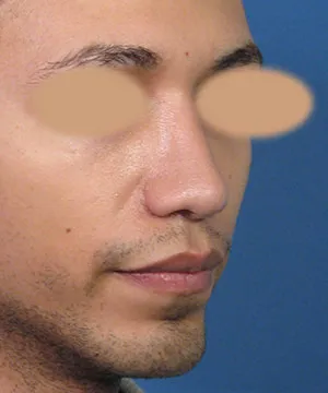 Oblique view of the face of a male African-American patient after the rhinoplasty