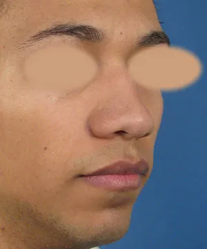 Oblique view of the face of a male African-American patient before the rhinoplasty