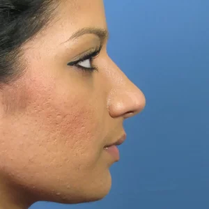 Profile view of a person with visible skin texture and acne scars on their cheek against a blue background.