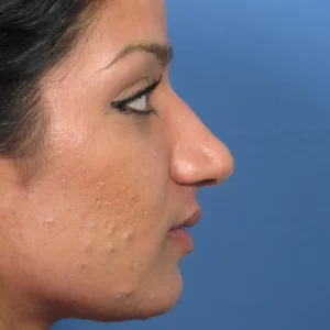 Profile view of a person with acne scars on their right cheek against a blue background.