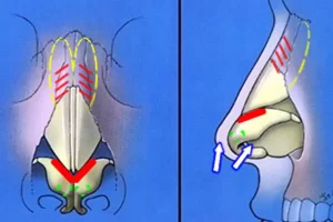 Medical diagram illustrating nasal anatomy from top and side views, highlighting cartilage, bones, and airflow paths with colored lines and arrows.