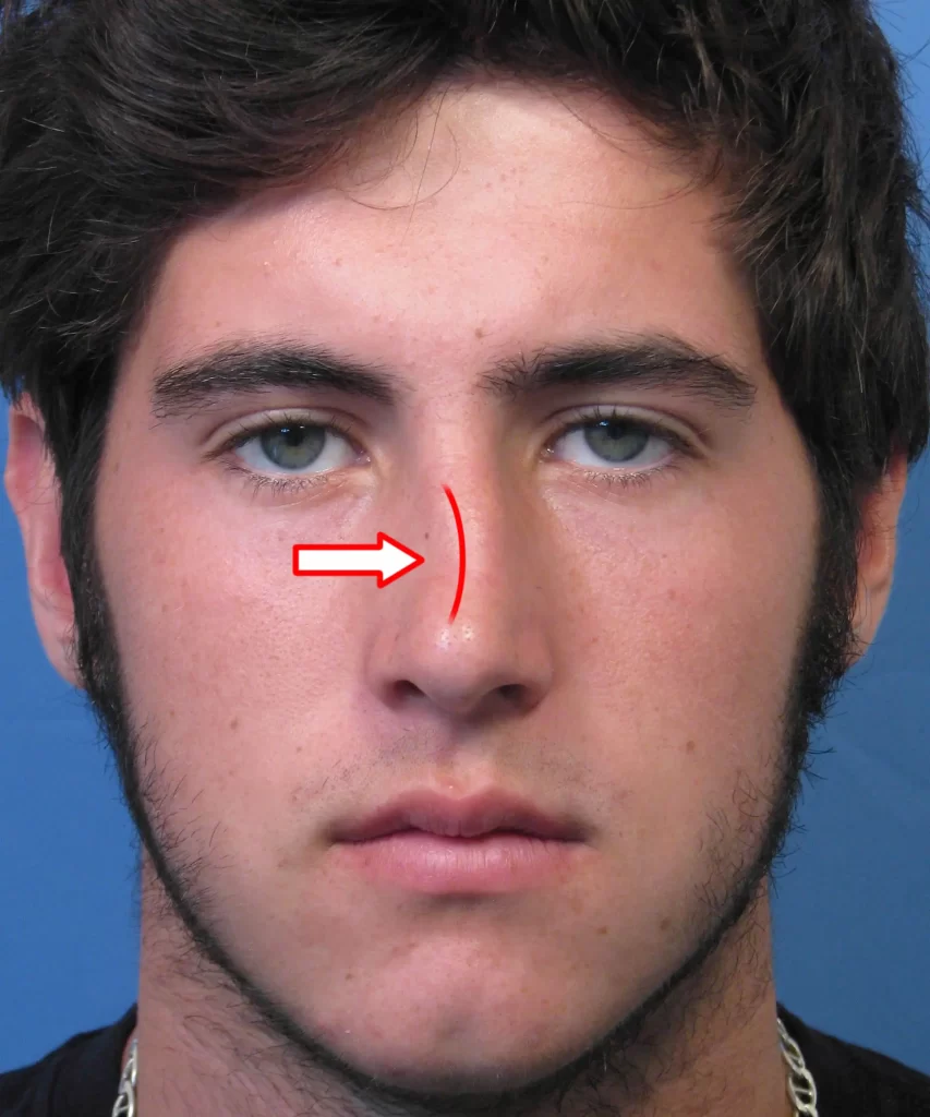 Front view of a person's face with a red line and arrow indicating a deviation on the nose.