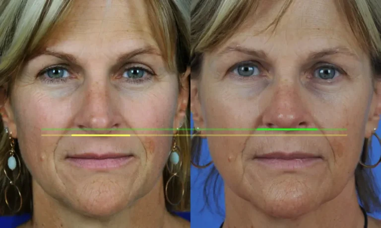 A side-by-side comparison of a woman's face showing subtle differences. Lines are drawn across her nose and mouth.