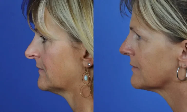 Side-by-side profile view of a woman before and after plastic surgery, showing changes in her nose and chin.