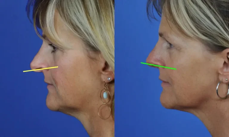 Side-by-side profile images of a woman's face showing before and after results of a nose procedure, with lines indicating changes in nasal contour.