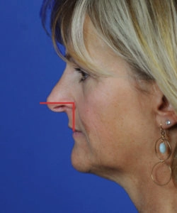 Profile view of a person's face with a red line highlighting the nose against a solid blue background.