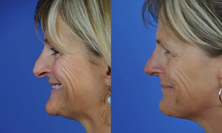 Side-by-side profile images of a person showing changes to the nose and chin area, before and after a procedure, against a blue background.