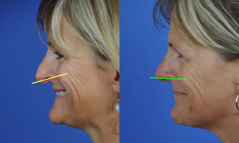 Side-by-side profile images of a woman before and after rhinoplasty, showing a straighter nose post-surgery.