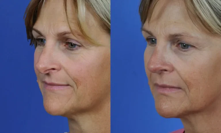 Side-by-side, before-and-after images of a woman showing changes in skin texture and complexion against a blue background.