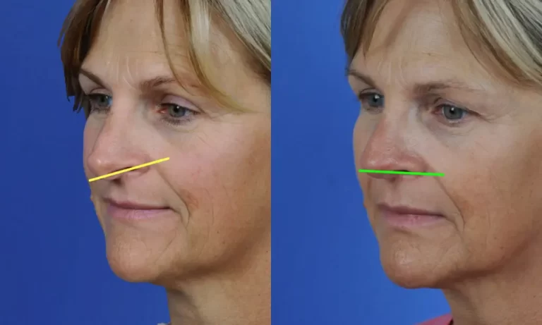 Side-by-side comparison of a woman's face before and after surgery, showing nose alignment changes with colored lines indicating differences.