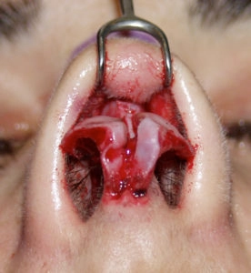 Close-up of a surgical procedure on a person's nose, showing exposed tissue and a medical instrument holding it open.