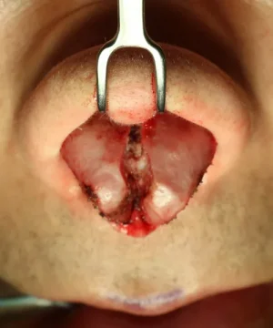 Close-up of a nasal surgery showing the septum exposed. Surgical tools are visible, with some redness and incisions on the tissue.