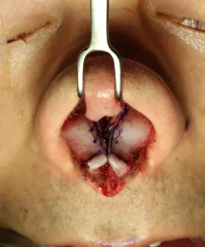 Close-up of a surgical procedure on a nose, showing exposed cartilage and stitches. A metal tool holds the nostrils open.