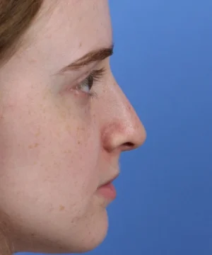 Profile view of a person with light skin against a blue background, focusing on the side of the face and nose.