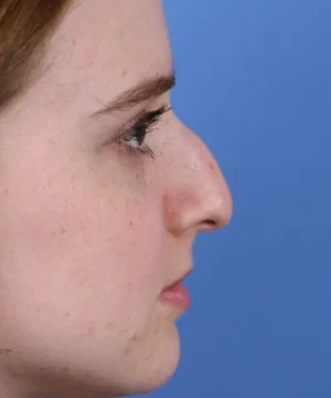 Profile view of a person with a fair complexion, focusing on the nose, against a blue background.