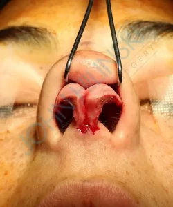 Close-up image of a person's nose during a surgical procedure, showing an open incision with surgical instruments positioned inside the nasal cavity.