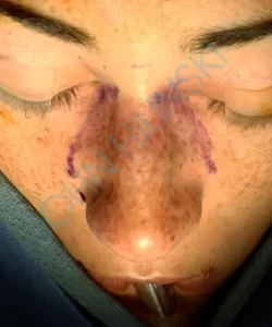 A close-up of a person's face lying down, with closed eyes and purple markings on the nose, possibly as guidelines for a medical procedure.