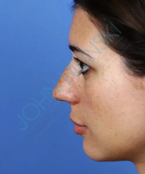 Profile view of a woman's face against a blue background, showing her side profile and nose.