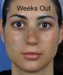 Close-up of a woman's face with text "Weeks Out" above her. She has noticeable freckles and wears a headband. Blue background.