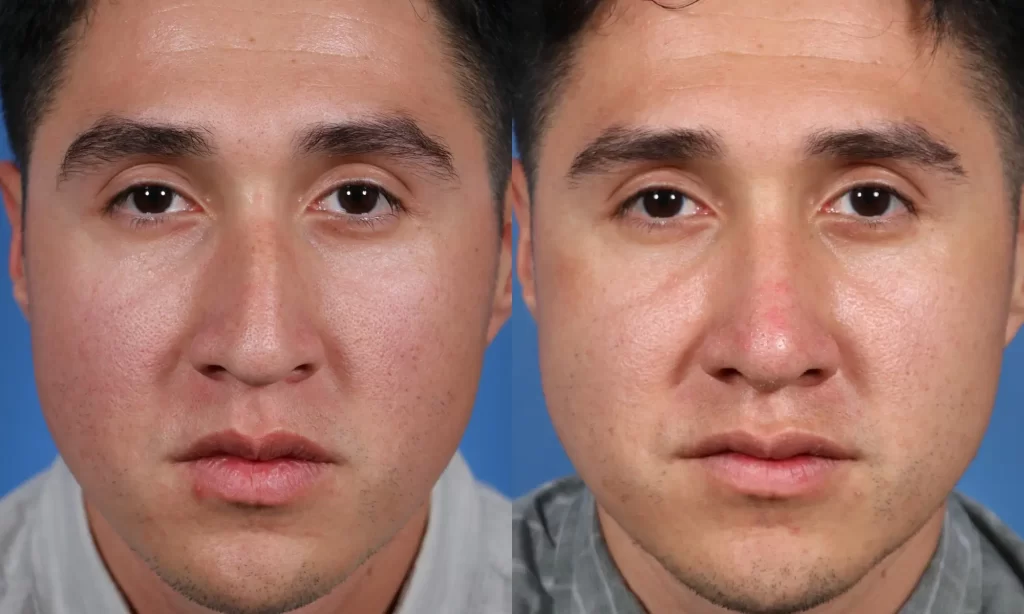 Close-up of a man's face before and after a skin treatment, showing changes in texture and tone.