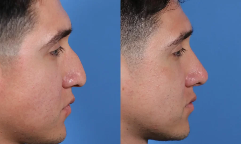 Side-by-side comparison of two profile views of a person's face, highlighting differences in nose shape before and after a surgical procedure.