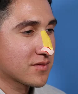 A person with a diagram showing nasal anatomy overlays, including the nasal bone and cartilage on their nose.