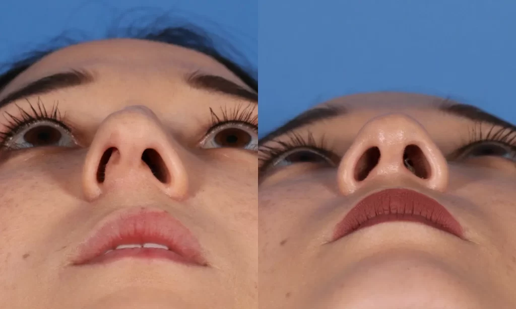 View of the female patient's nose base before and after Scarless Rhinoplasty