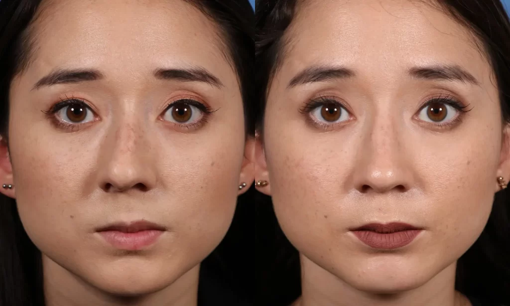 Front view of the face of a female patient before and after Scarless Rhinoplasty