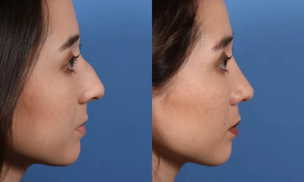 Lateral view of the face of a female patient before and after Scarless Rhinoplasty