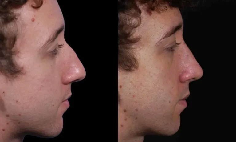 Side-by-side comparison of a person's profile before and after a rhinoplasty, showing differences in nose shape.