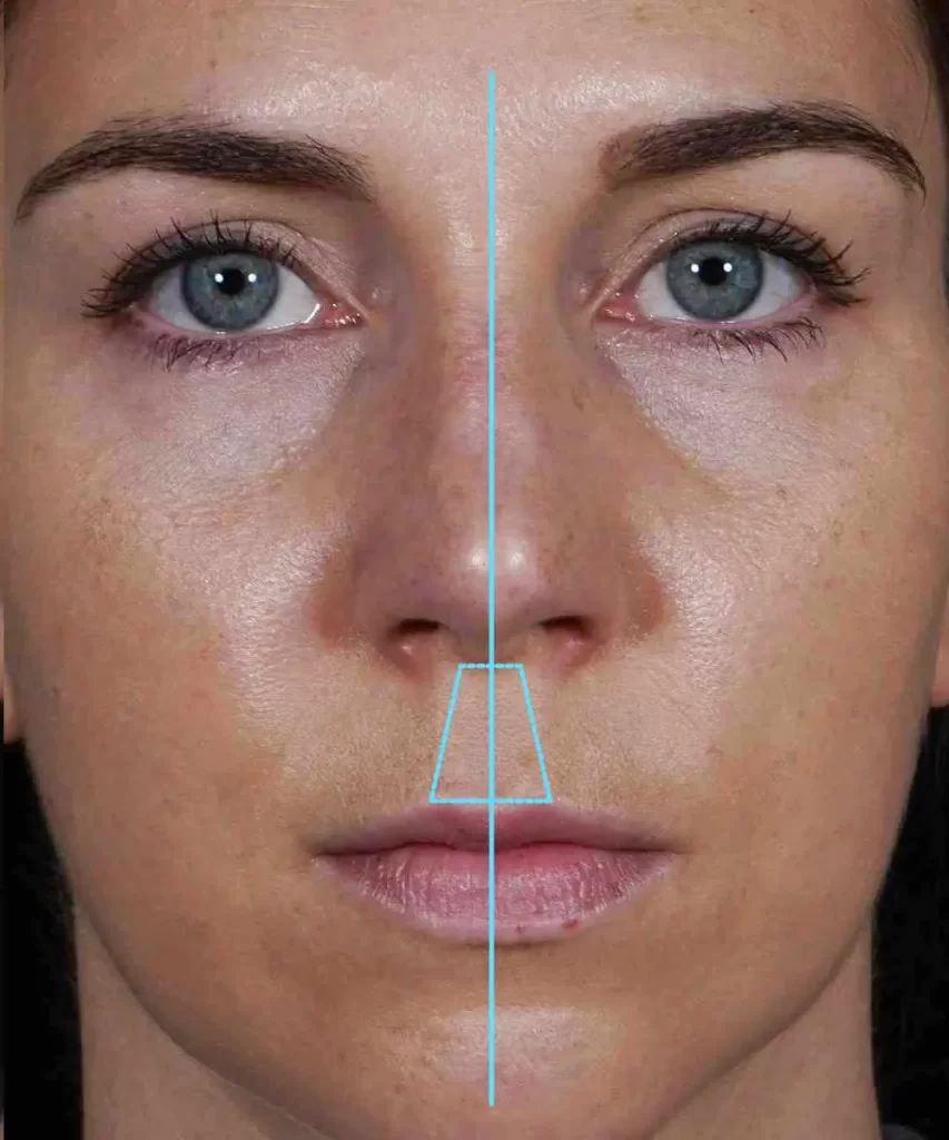 A woman's face with a blue line down the center and a trapezoid shape over the nose, highlighting facial symmetry.