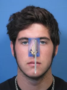 A person with a diagram illustrating nasal anatomy and surgical lines overlaid on their nose.