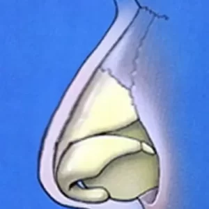 Cross-sectional illustration of a human nose showing the internal nasal structure against a blue background.