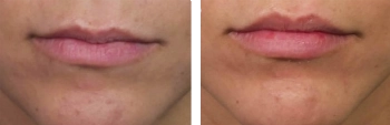 Close-up of two images showing the before and after effects on a person's lips, illustrating changes in fullness and shape.