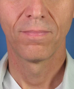 A close-up image of the lower part of a man's face showing a neutral expression, focusing on the mouth and chin, against a blue background.