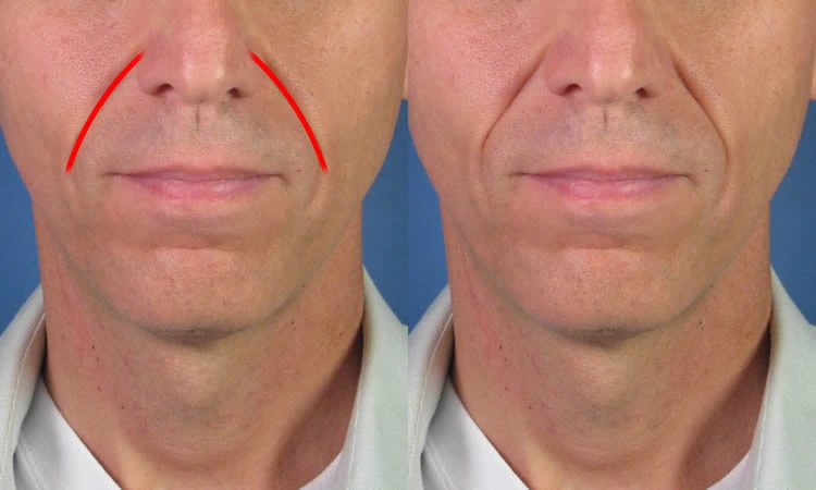 Before-and-after comparison showing a man's face. The left image highlights laugh lines with red lines, while the right image shows reduced laugh lines.