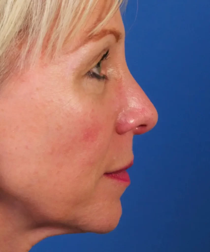 Lateral view of the face of a female patient with nose asymmetric tip collapse after rhinoplasty with cartilage graft