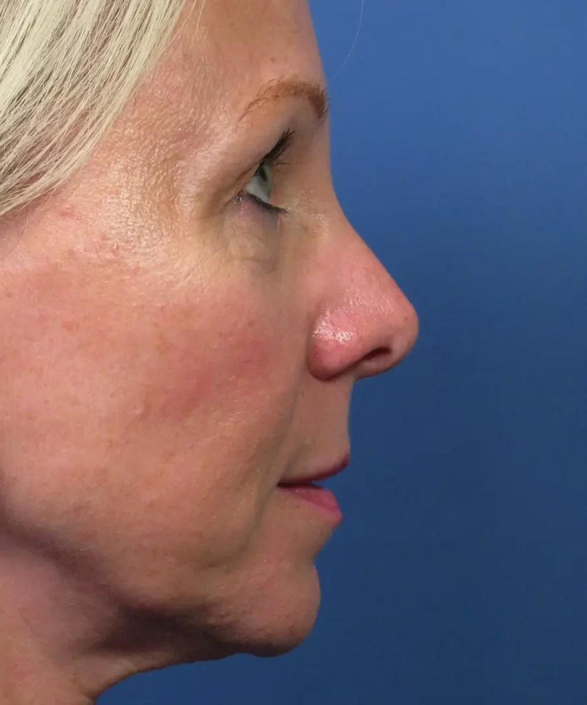 Lateral view of the face of a female patient with nose asymmetric tip collapse before rhinoplasty