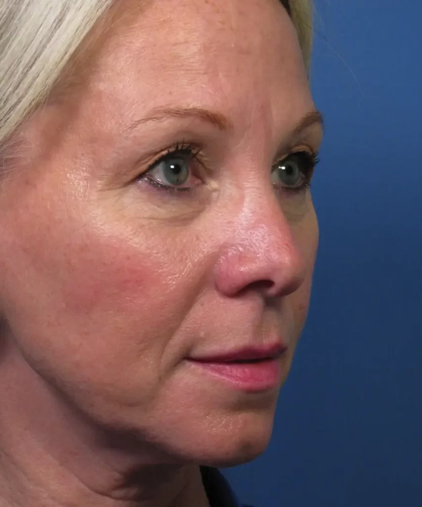 Oblique view of the face of a female patient with nose asymmetric tip collapse before rhinoplasty 