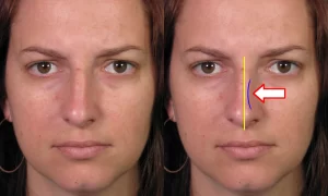 Two side-by-side photos of a woman's face show changes in the nose shape, with an arrow indicating a shift.