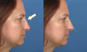 Side-by-side images of a woman's profile before and after a rhinoplasty, showing a straighter nose and reduced hump. Yellow arrow and line highlight the changes in the nasal structure.