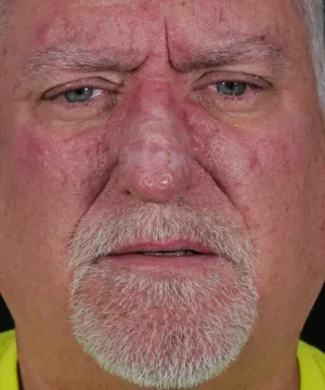 Close-up of an older man with a serious expression, visible rosacea on his face, and white hair and beard. He is wearing a bright yellow shirt.