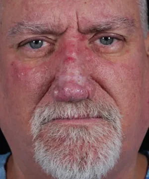 Close-up of an older man with a white beard, showing facial redness and visible pores, likely indicating a skin condition.