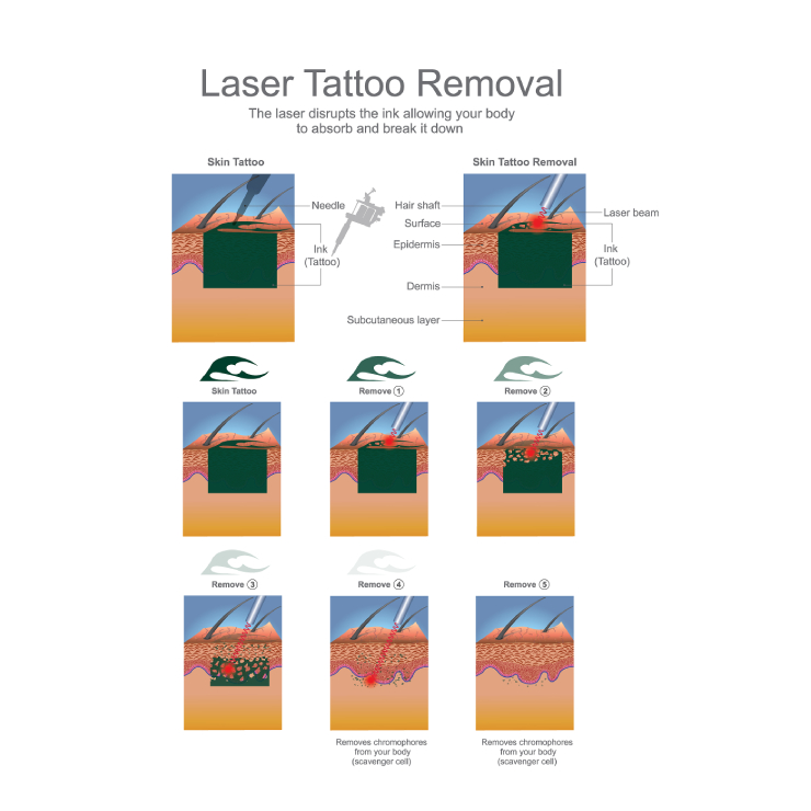 Diagram explaining the process of laser tattoo removal, showing skin layers, ink disruption by laser beams, and subsequent breakdown by the body's natural processes.