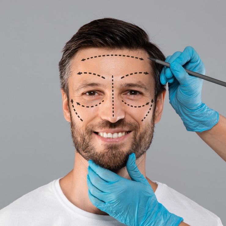 Man smiling with dotted lines on his face, wearing a white shirt. Gloved hands hold a pencil near his temple and chin, suggesting cosmetic procedure planning against a gray background.