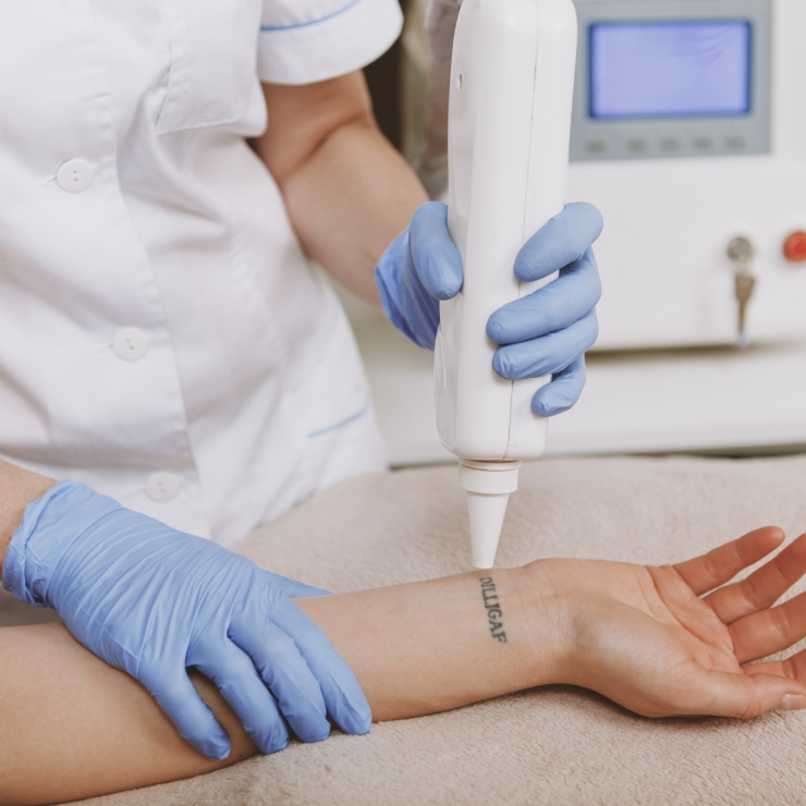 A person wearing gloves uses a laser device on a tattooed arm.