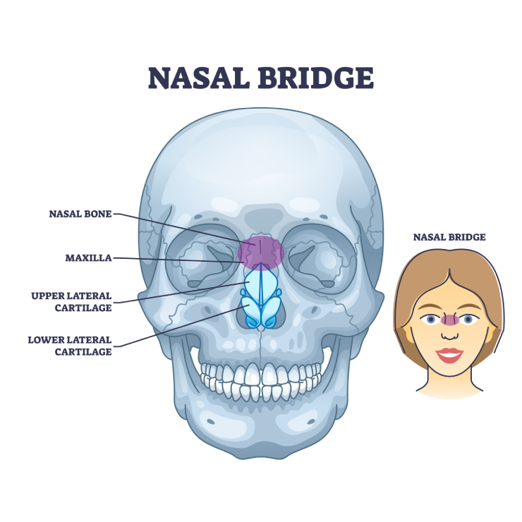 Illustration of a skull highlighting the nasal bridge and associated structures, with a side image of a person showing the nasal bridge's location.