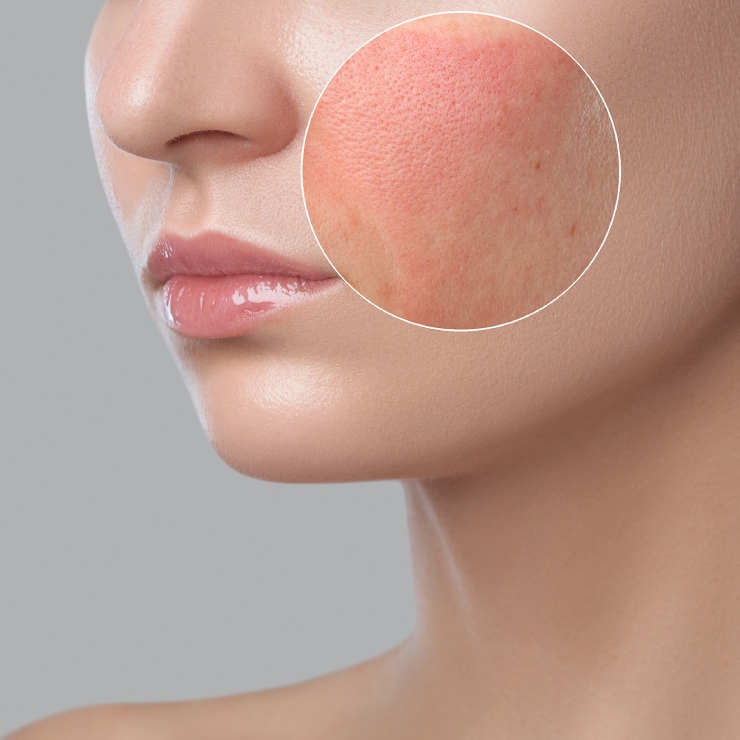 Close-up of a woman's face with a magnified inset highlighting redness and uneven skin texture on her cheek.