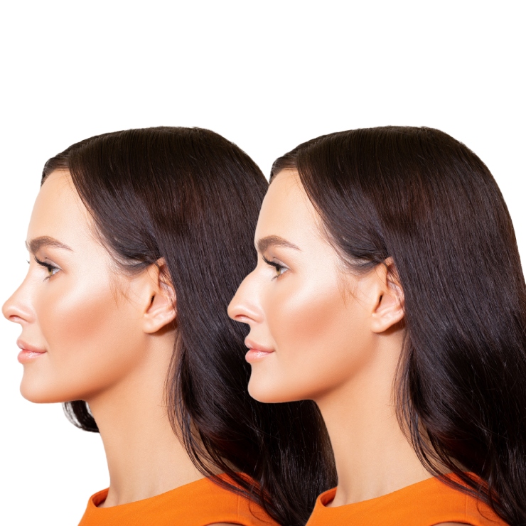 Side-by-side profiles of a woman with dark hair showing her nose before and after cosmetic surgery, with noticeable changes in shape.