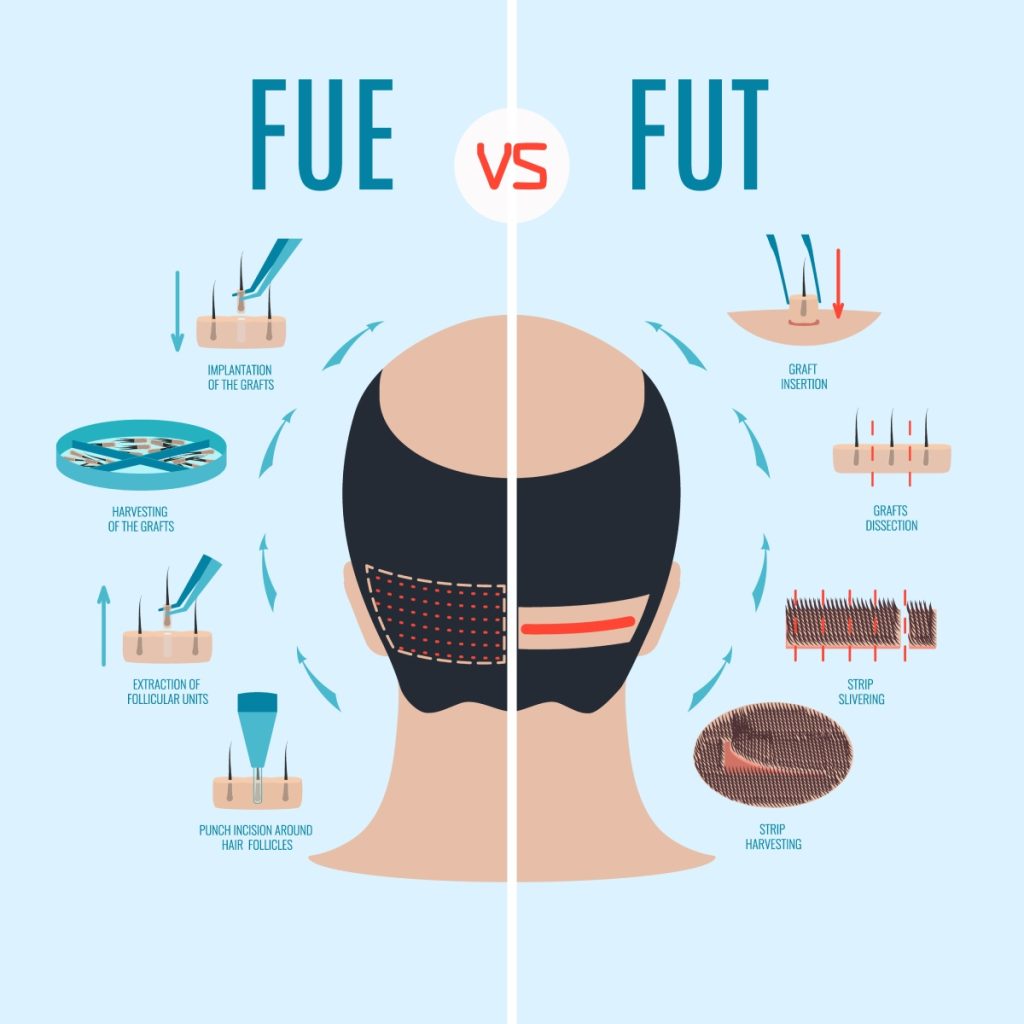 Illustration comparing FUE and FUT hair transplant methods, showing steps like graft harvesting and implantation on the back of a head.